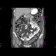 Peritoneal carcinosis: CT - Computed tomography
